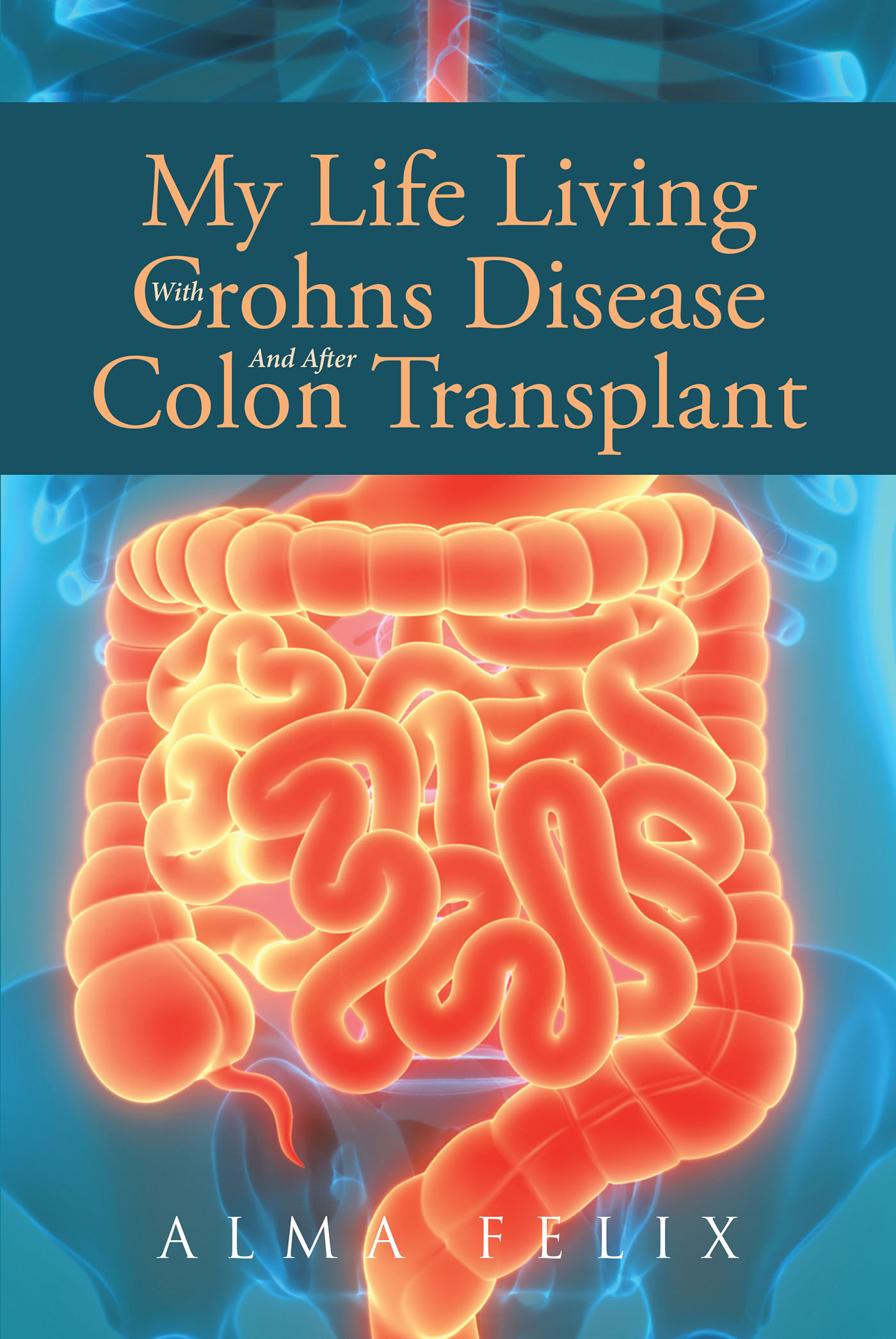 My Life Living With Crohns Disease And After Colon Transplant Surgery Cover Image